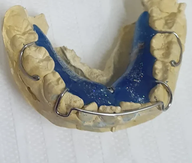 Aparelho ortopédico de acrílico azul com glitter, sobre o modelo de gesso